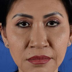 Ethnic Rhinoplasty Before & After Patient #1973