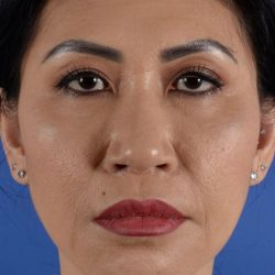 Ethnic Rhinoplasty Before & After Patient #1973