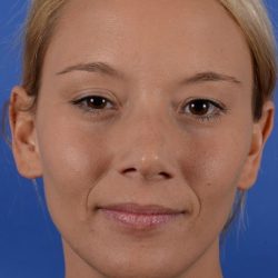 Primary Rhinoplasty Before & After Patient #1718