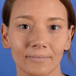 Primary Rhinoplasty Before & After Patient #1718