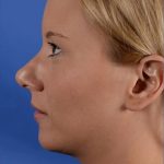 Primary Rhinoplasty Before & After Patient #1718