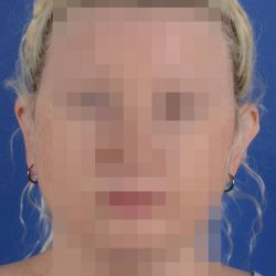 Otoplasty Before & After Patient #2110