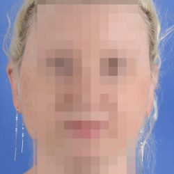 Otoplasty Before & After Patient #2110