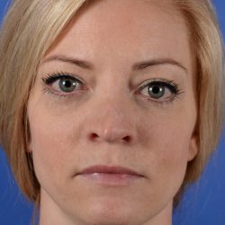 Revision Rhinoplasty Before & After Patient #2466