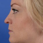 Revision Rhinoplasty Before & After Patient #2466