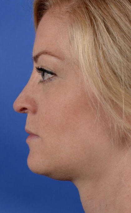 Revision Rhinoplasty Before & After Patient #2466