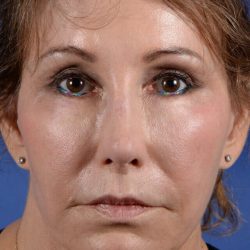 Revision Rhinoplasty Before & After Patient #2467