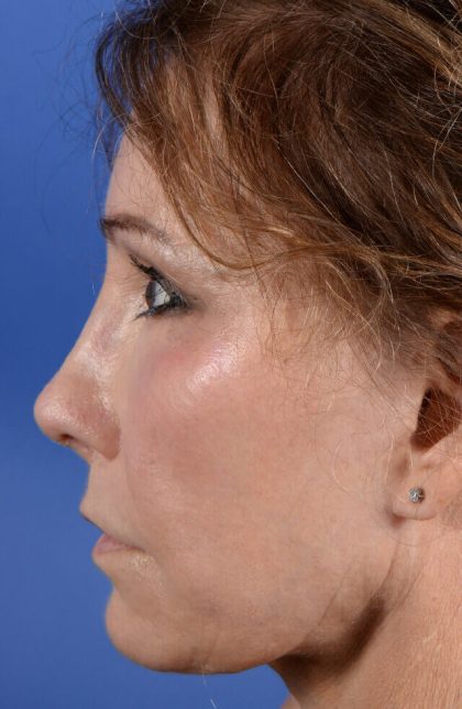 Revision Rhinoplasty Before & After Patient #2467