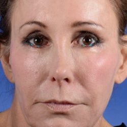 Revision Rhinoplasty Before & After Patient #2467