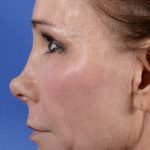 Revision Rhinoplasty Before & After Patient #2467