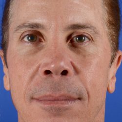 Revision Rhinoplasty Before & After Patient #2468