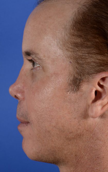 Revision Rhinoplasty Before & After Patient #2468