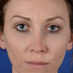 Revision Rhinoplasty Before & After Patient #2470