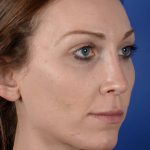 Revision Rhinoplasty Before & After Patient #2470