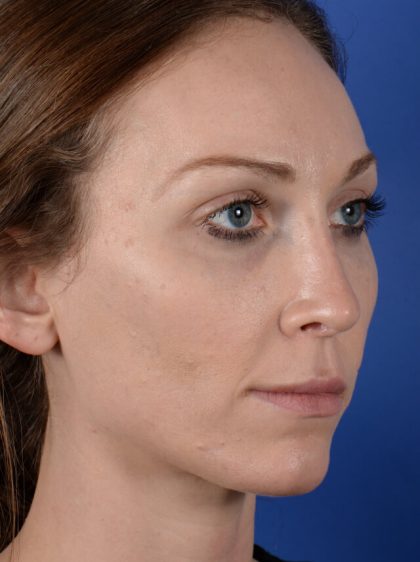Revision Rhinoplasty Before & After Patient #2470