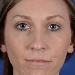 Revision Rhinoplasty Before & After Patient #2470