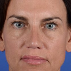 Revision Rhinoplasty Before & After Patient #2517