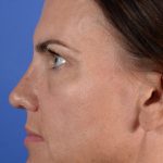 Revision Rhinoplasty Before & After Patient #2517