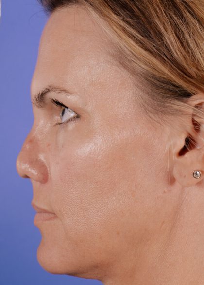 Revision Rhinoplasty Before & After Patient #2517