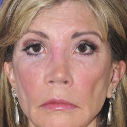 Revision Rhinoplasty Before & After Patient #2518