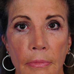 Revision Rhinoplasty Before & After Patient #2518