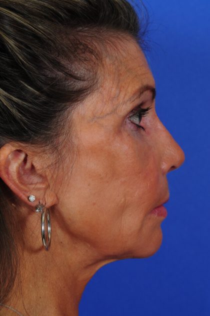 Revision Rhinoplasty Before & After Patient #2518