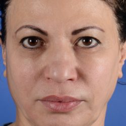 Revision Rhinoplasty Before & After Patient #2519