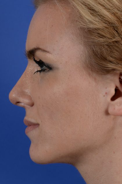 Revision Rhinoplasty Before & After Patient #2520