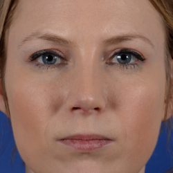 Revision Rhinoplasty Before & After Patient #2521