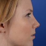 Revision Rhinoplasty Before & After Patient #2521