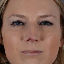 Revision Rhinoplasty Before & After Patient #2521