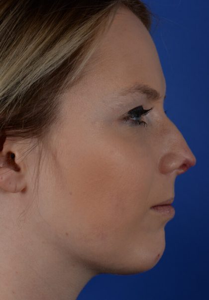 Revision Rhinoplasty Before & After Patient #2521