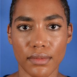Facial Reshaping Before & After Patient #2843