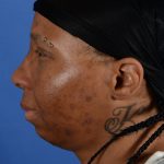 Facial Reshaping Before & After Patient #2844