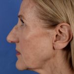 Face Lift - Neck Lift Before & After Patient #3002