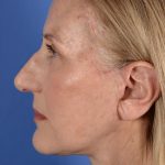 Face Lift - Neck Lift Before & After Patient #3002