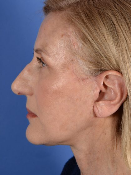 Face Lift - Neck Lift Before & After Patient #3002