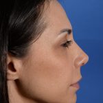 Revision Rhinoplasty Before & After Patient #3019