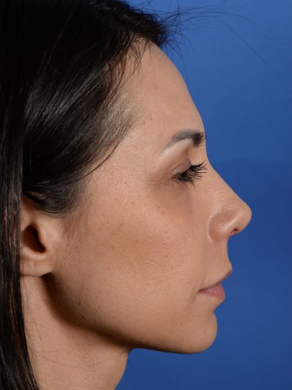 Revision Rhinoplasty Before & After Patient #3019