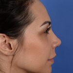 Revision Rhinoplasty Before & After Patient #3019