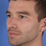 Facial Reshaping Before & After Patient #3003