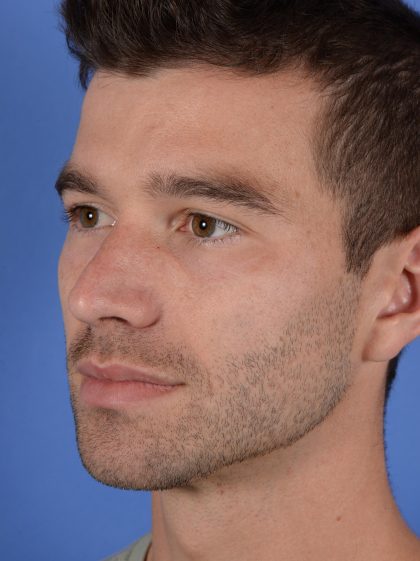 Facial Reshaping Before & After Patient #3003