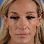 Primary Rhinoplasty Before & After Patient #2966