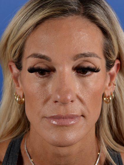 Primary Rhinoplasty Before & After Patient #2966