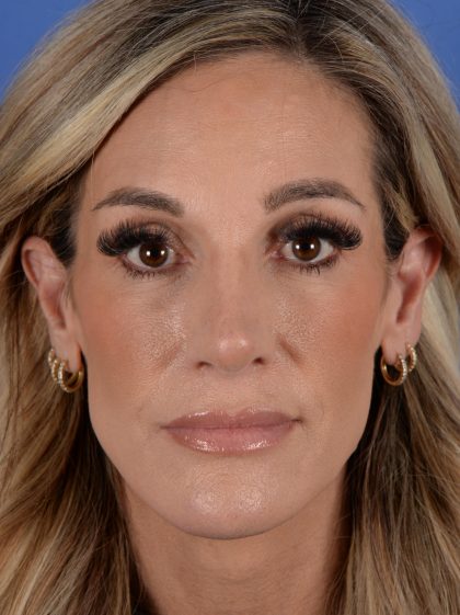 Primary Rhinoplasty Before & After Patient #2966