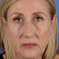 Face Lift - Neck Lift Before & After Patient #3002
