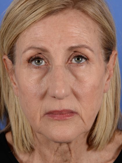 Face Lift - Neck Lift Before & After Patient #3002