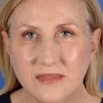 Face Lift - Neck Lift Before & After Patient #3002