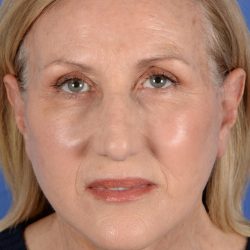Face Lift - Neck Lift Before & After Patient #3002