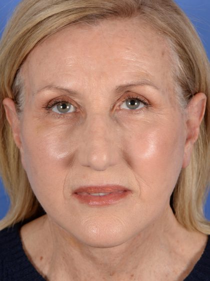Face Lift - Neck Lift Before & After Patient #3002